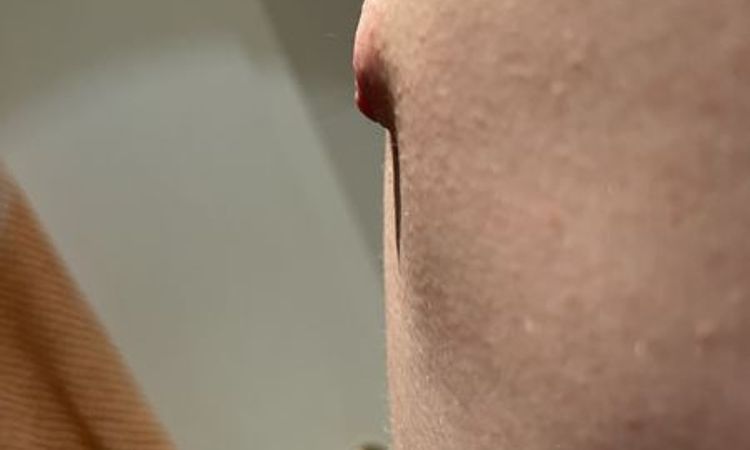 Spitze & Hervorstehende Brustwarzen nach Gynäkomastie OP - 64801