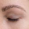 Atrophe, sichtbare Narben nach Augenlidkorrektur (über 1 Jahr her)