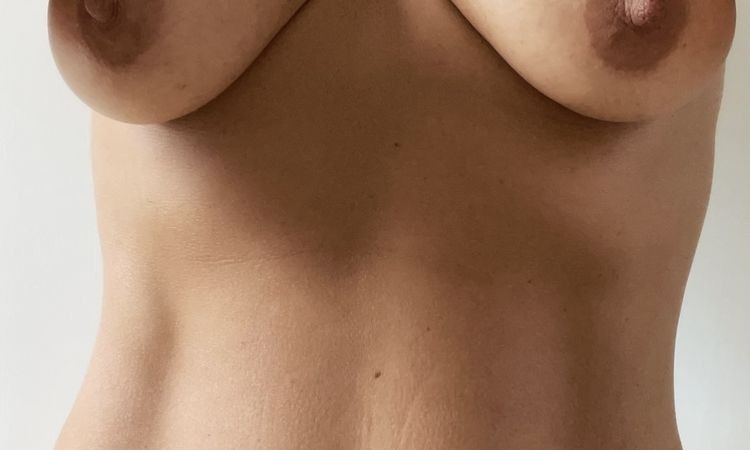 Bitte um Zweitmeinung nach Brustvergrößerung und -straffung - 64862