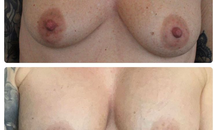 Brustwarzen nach BV zu weit unten - 64960