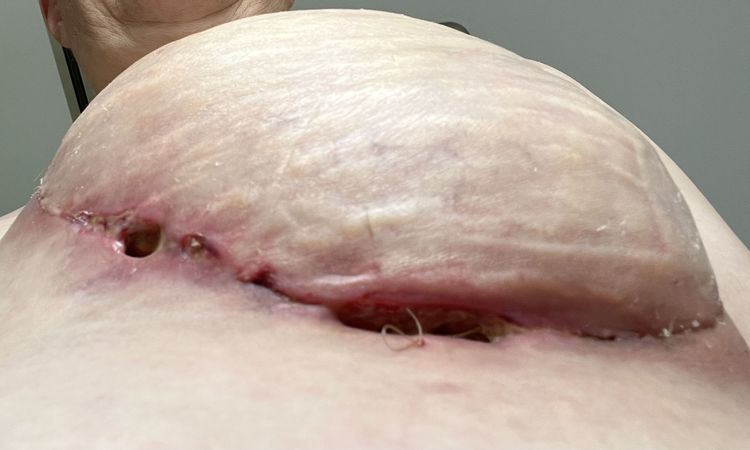 Offene Stellen an OP Naht nach DIEP-Flap - 64971