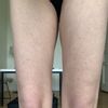 Suche Behandlung für Fettentfernung und Hautstraffung an den Beinen