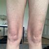 Suche Behandlung für Fettentfernung und Hautstraffung an den Beinen - 65156