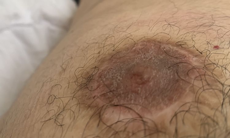 Gyso Op- Btustwarzen heilen nicht endgültig ab (seit 8 Monaten, nässen Jucken) - 65194