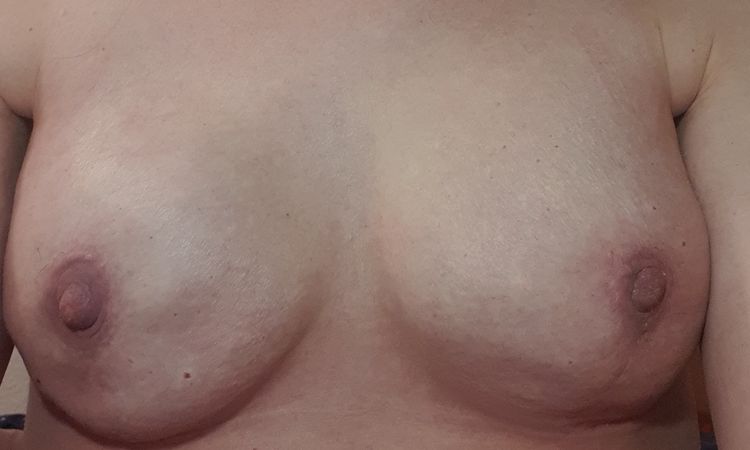 Implantatwechsel und extrem unglücklich - 65235