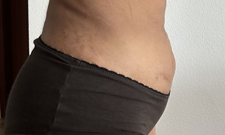 Dicker Unterbauch nach Liposuction - 65511