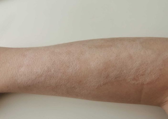 Narben nach Dermabrasion