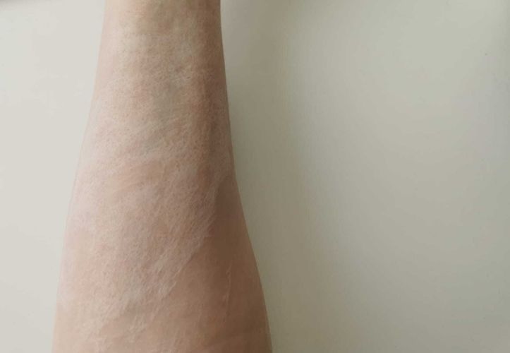 Narben nach Dermabrasion