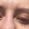 Wieso sind meine Augen so faltig nach Blephoraplasty?