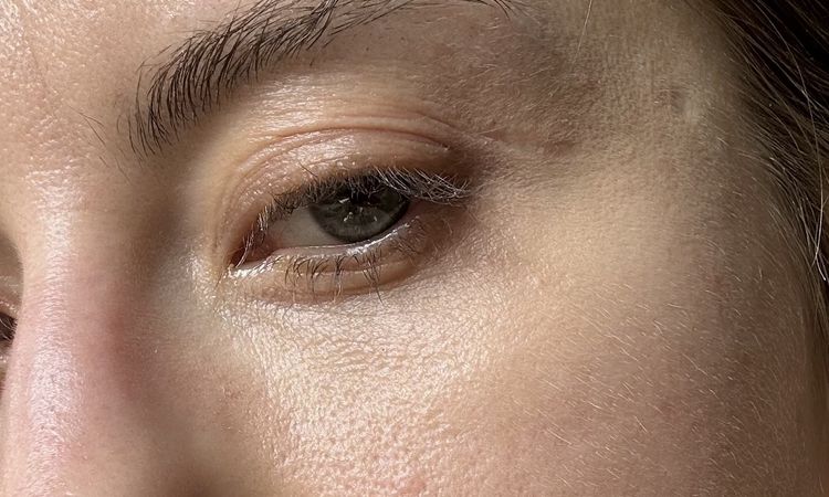 Wieso sind meine Augen so faltig nach Blephoraplasty? - 65810