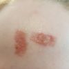 Wunde infiziert ? Nach co2 laser