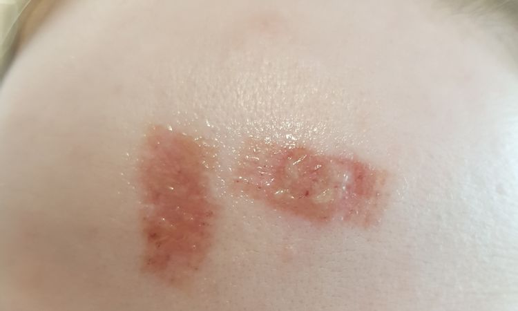 Wunde infiziert ? Nach co2 laser - 66018