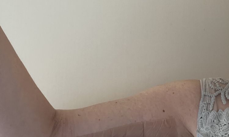 Oberarmstraffung, aber keine Veränderungen - 66043
