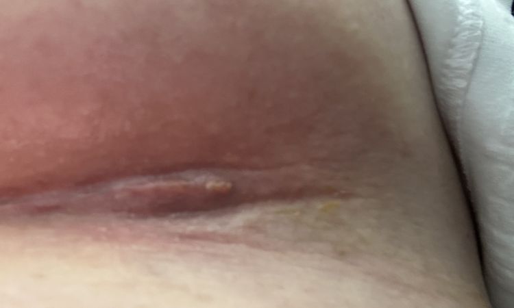 Brustvergröserung Wunde - 66296