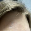 Behandlung von tiefen Narben im Gesicht/Narbenkorrektur - 66437