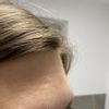 Behandlung von tiefen Narben im Gesicht/Narbenkorrektur - 66438