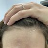 Behandlung von tiefen Narben im Gesicht/Narbenkorrektur - 66439