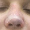 Fat Graft ( Eigenfettunterspritzung ) Nase entfernen?