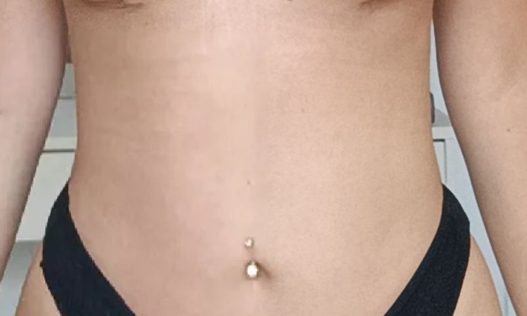 Nach Bruststraffung Vergrößerung mit Eigenfett oder Implantaten? - 66629