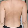 Nach Bruststraffung Vergrößerung mit Eigenfett oder Implantaten?