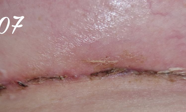 4 Wochen Post OP, Sorge um Narbe - 66740