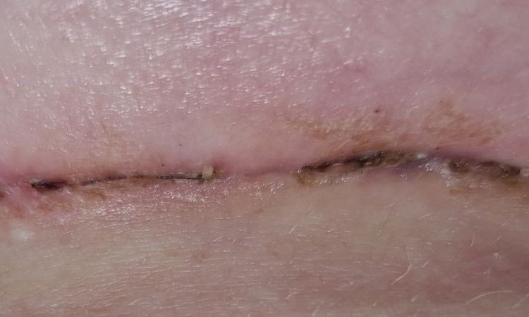 4 Wochen Post OP, Sorge um Narbe - 66741