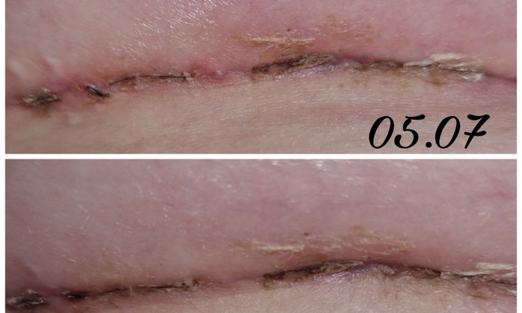 4 Wochen Post OP, Sorge um Narbe - 66742