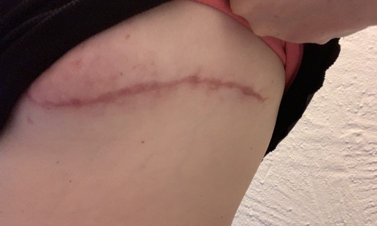 Brustverkleinerung/ Korrektur? - 66748