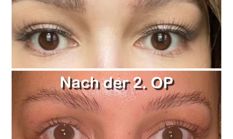 Enophthalmus nach Oberlidstraffung? - 66808