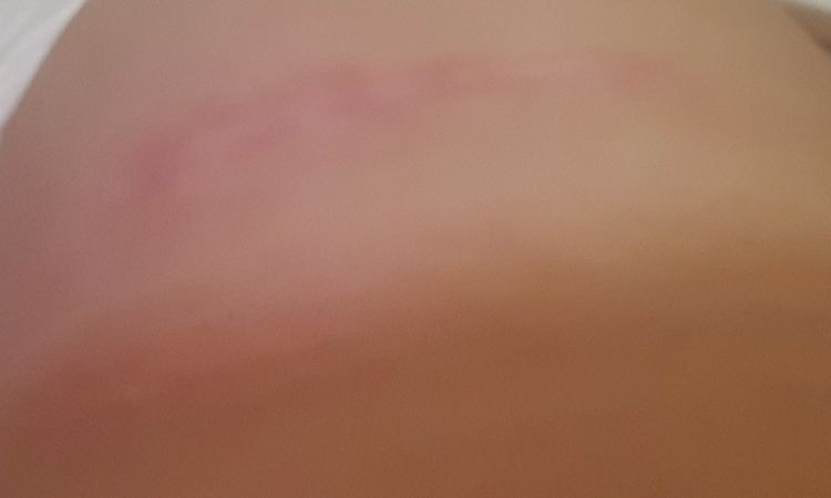 Narbe nach Brust OP zu weit oben - 66817