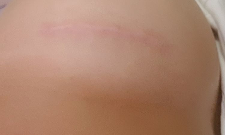 Narbe nach Brust OP zu weit oben - 66819