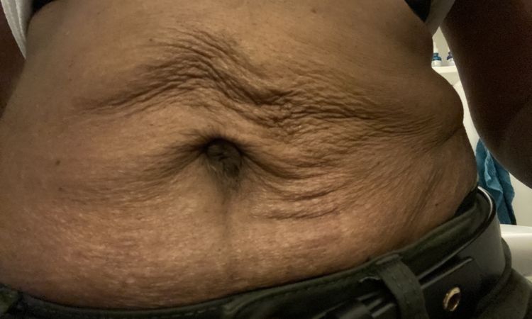 Status nach Bauchwandstraffung - 66894