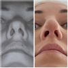 3 Monate nach Nasenkorrektur, Knorpel in der Nase, zweite OP - 67202