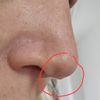 3 Monate nach Nasenkorrektur, Knorpel in der Nase, zweite OP - 67203