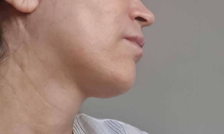 Facelift und Necklift - eine Seite stärker gezogen - 67348