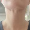 Missglückte Fettabsaugung am Doppelkinn?