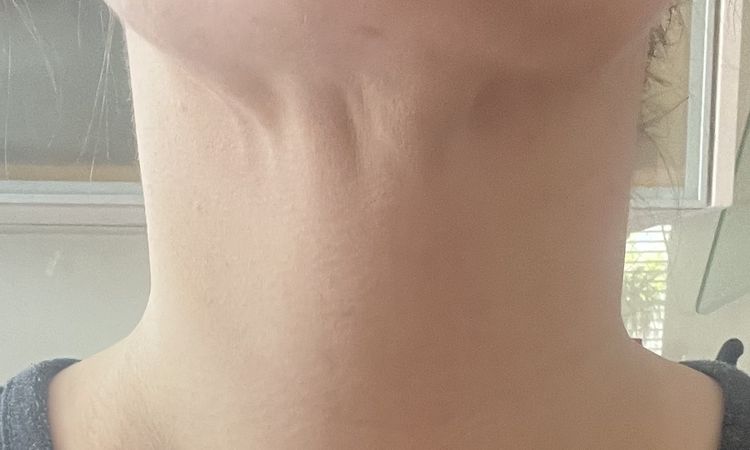 Missglückte Fettabsaugung am Doppelkinn? - 67454