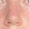 Dicke &  harte Nasenspitze 7 Monaten nach Nasenkorrektur - 67473