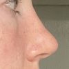 Dicke &  harte Nasenspitze 7 Monaten nach Nasenkorrektur - 67474