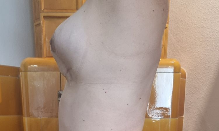 Bruststraffung mit Implantate - 67494