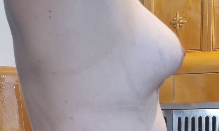 Bruststraffung mit Implantate - 67496