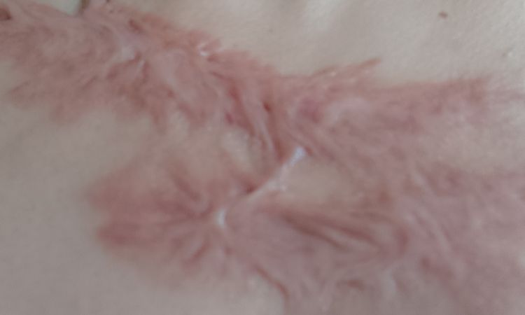 Narben,Hypertrophe Keloide - 67636