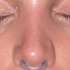 Nase nach OP immernoch asymmetrisch (Nasenflügel / Septum) - 67844