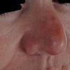 Nasenschwellkörper asymmetrisch nach Revision - 67992