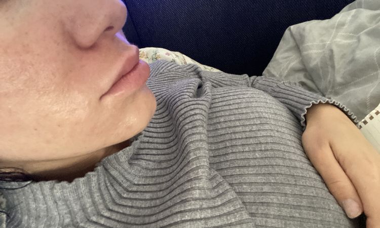 Facelift mit 28 Jahren möglich ? - 68076