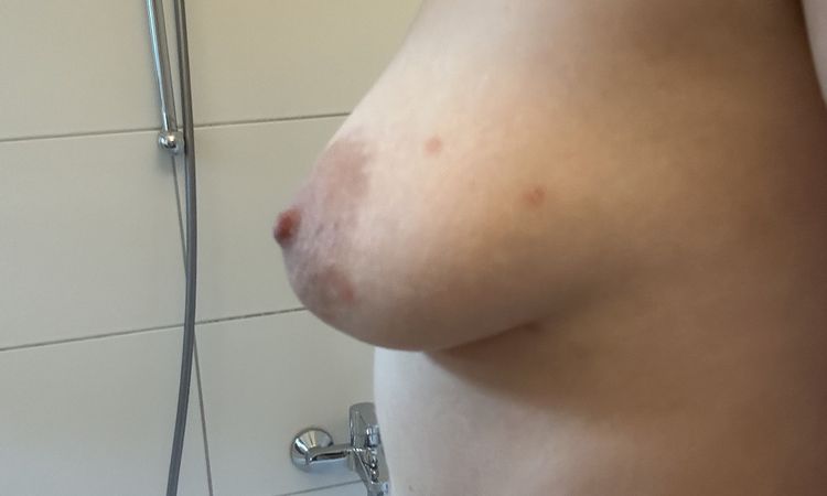 Ist meine Brust tubulär? Brustvergrößerung - 68266