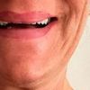 Behandlungsmöglichkeiten: Schneidezähne beim Lachen kaum sichtbar