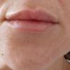 Lippen aufspritzen Falte