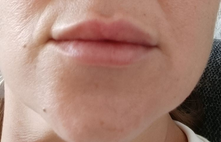 Lippen aufspritzen Falte