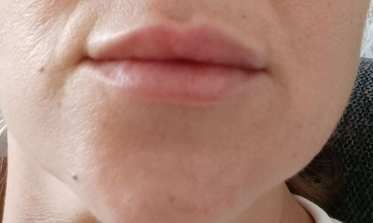 Lippen aufspritzen Falte - 68406